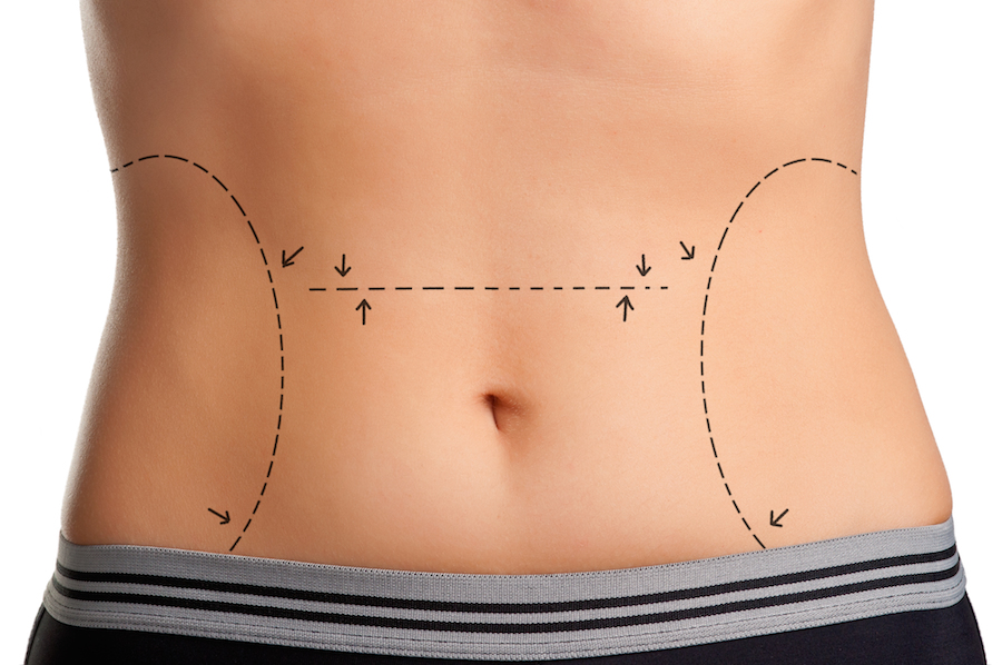 liposuction for love handles