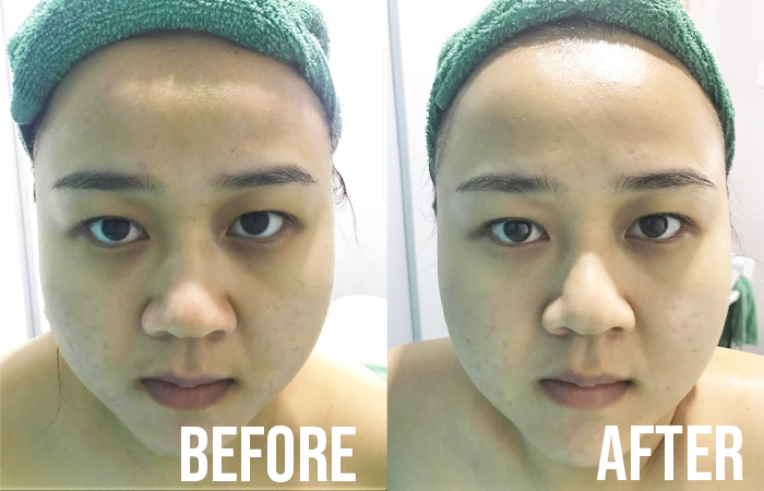 Celmonze Signature Plus Facial Review Eunice