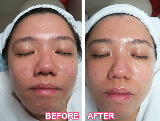 hydration facials indulgence beauty before after