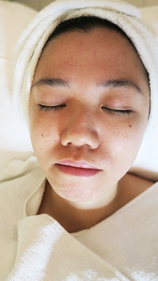 facial for acne le facialle 3