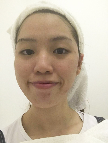 Extraction Facial Singapore Derma Lab 3