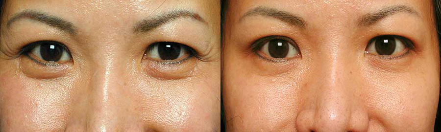 How To Prevent And Cure Crows Feet For Asian Eyes 8