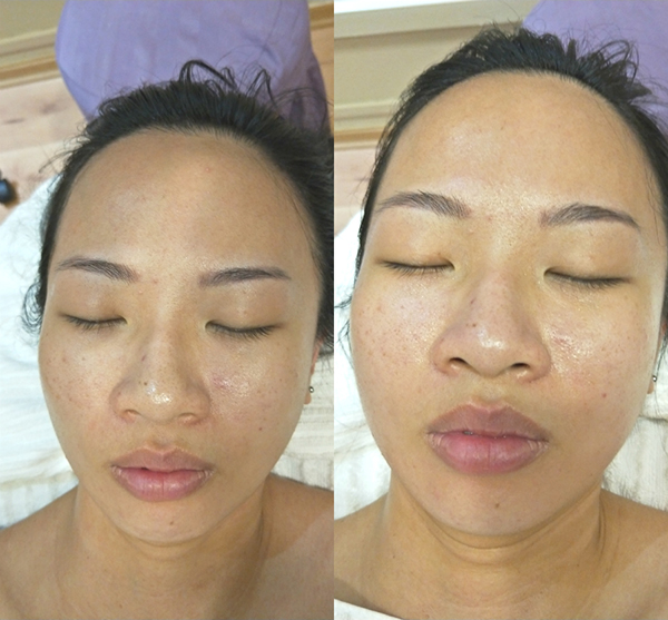 Best Sensitive Skin Facials Before And After Mask Application