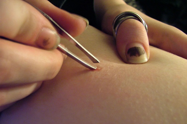 Tweezing ingrown hair with tweezers