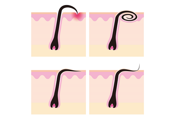 Ingrown hair diagram