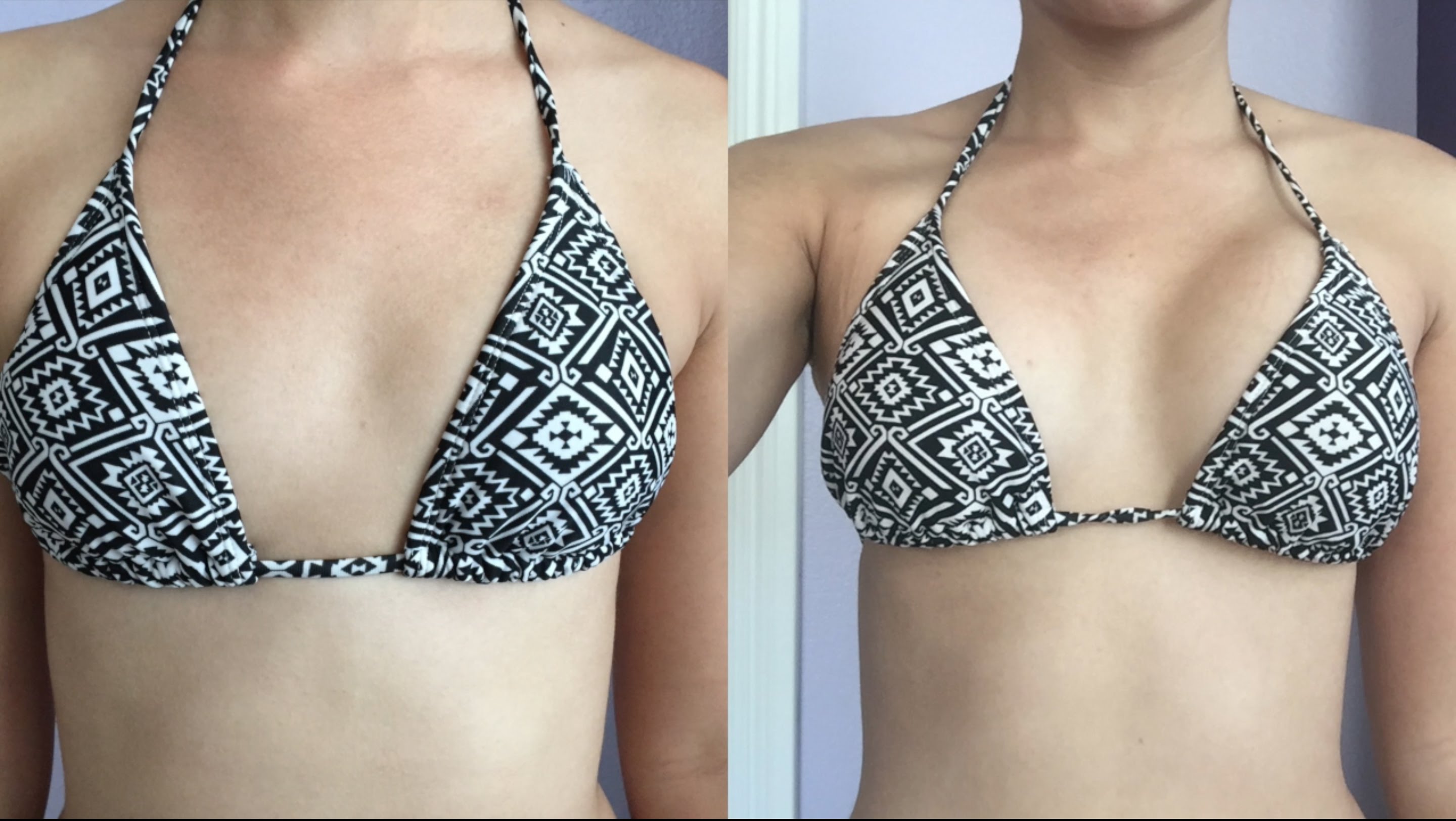 Breast Augmentation 1