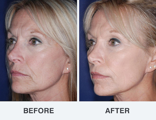 Fat grafting can be used to fill sunken areas on the face.