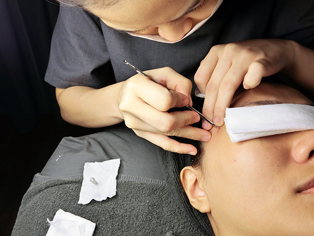 Best Acne Facial Porcelain Process