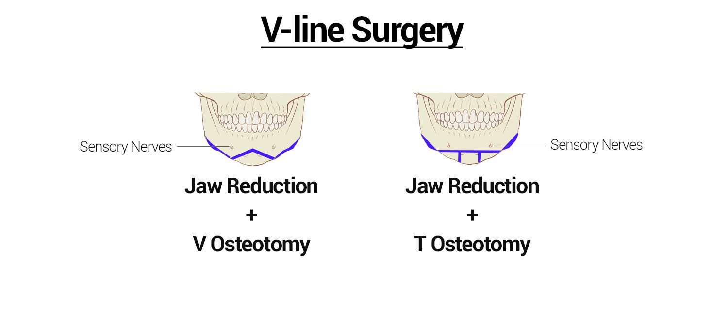 V line Vs Mini V line Surgery What s The Difference Daily Vanity V line Vs Mini V line Surgery What s The Difference Daily Vanity
