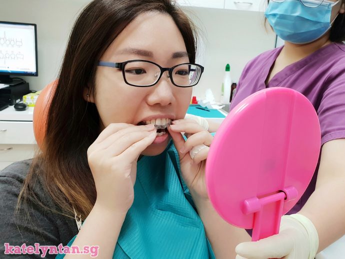 Zenyum Everything you want to know about the cheaper invisible braces, including costs and user