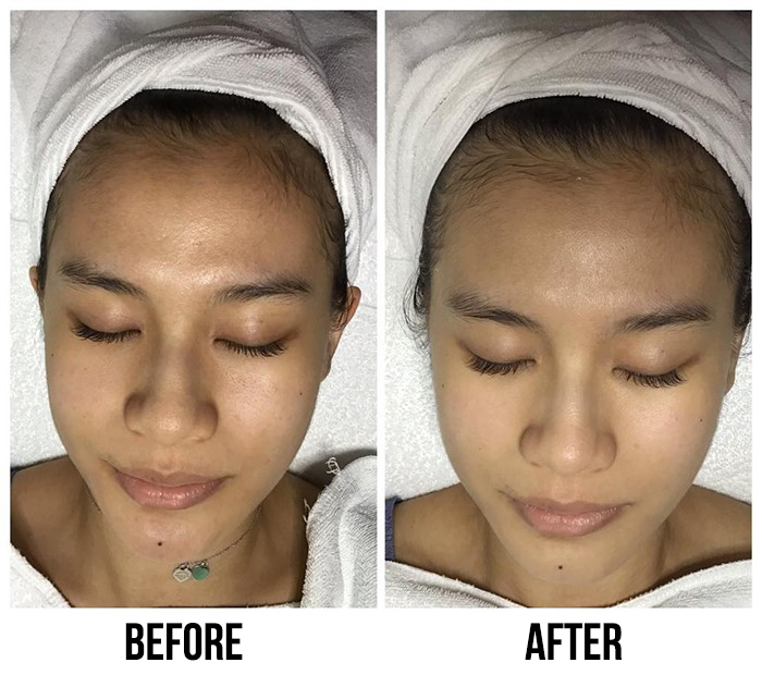 Caring Skin A+ Hydrogen Treatment Before After 1