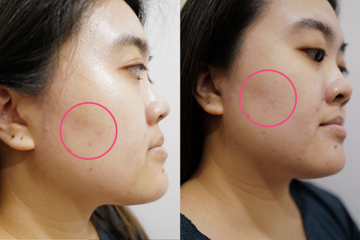 Bioskin Facial Review Before Left After Right