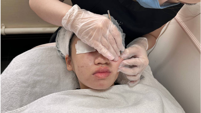 acne facial - glomax aesthetics clinic (5)
