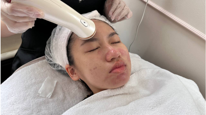 acne facial - glomax aesthetics clinic (6)