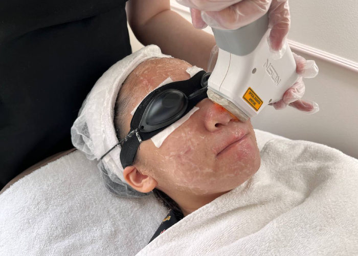 acne facial - glomax aesthetics clinic (8)