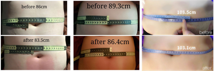 body sculpting singapore