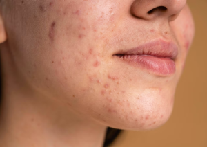 The best Japanese skincare products for acne-prone skin, according to