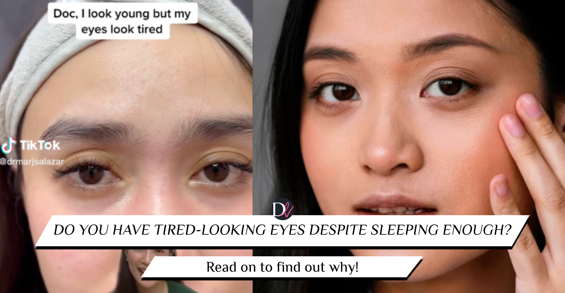 Deusaderm For Dark Eye Circles