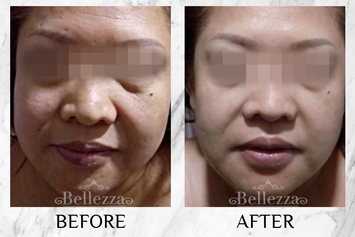 5D Collagen V-Boost Plus+ Face Treatment by Bellezza Aesthetics