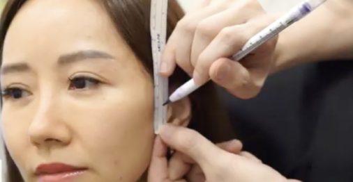 Feature image thread lift