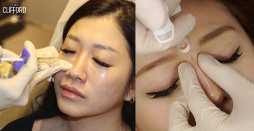 nose fillers featured image