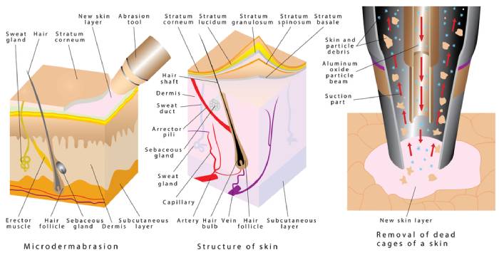 microdermabrasion explanation