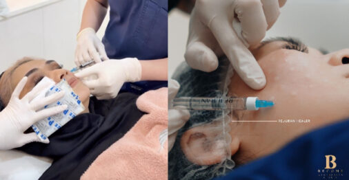 rejuran skin booster - singapore (5)