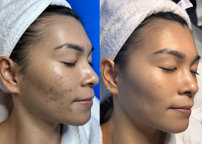 12.12 deals 12.12 beauty services new york skin solutions cica acne treatment