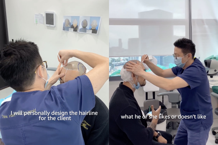 hair transplant singapore - hairline