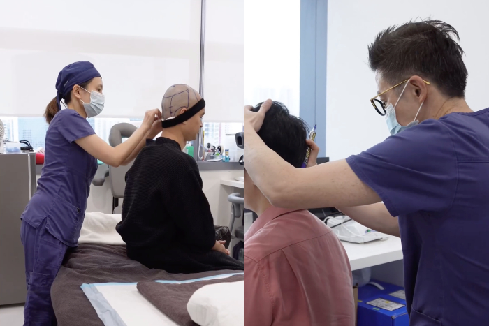 hair transplant singapore - shave or no shave