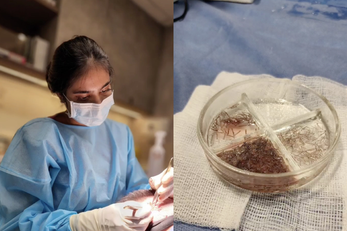 hair transplant singapore