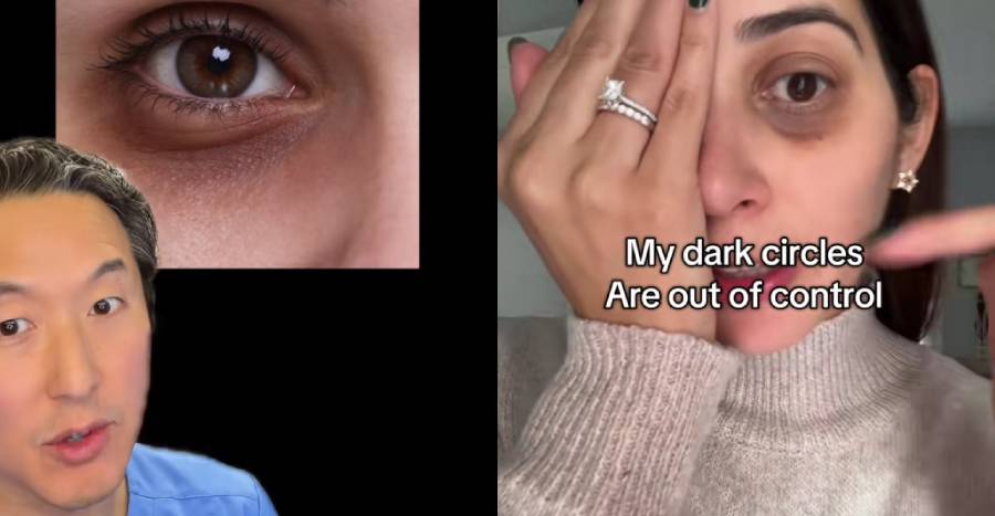 get rid dark eye circles singapore 1