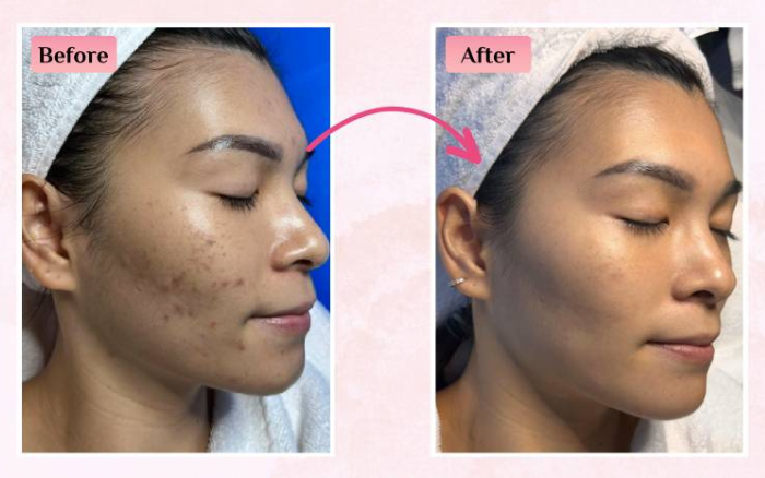 NYSS Cica Acne treatment