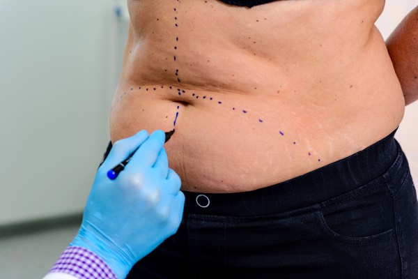 liposuction treatment procedure 