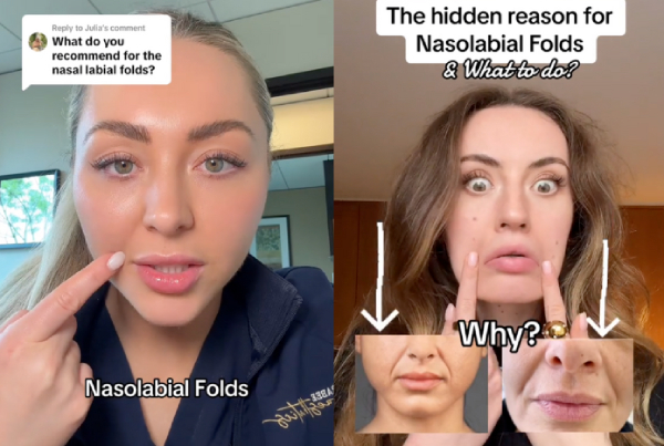 nasolabial folds causes