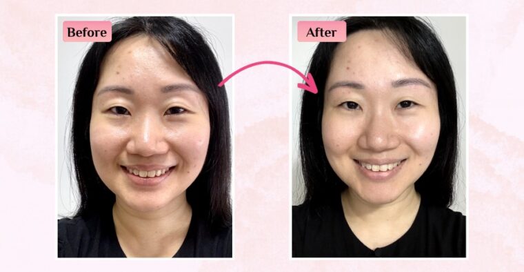 Aura Medical Aesthetics AURA Medical Aesthetics Signature UltraLift Treatment