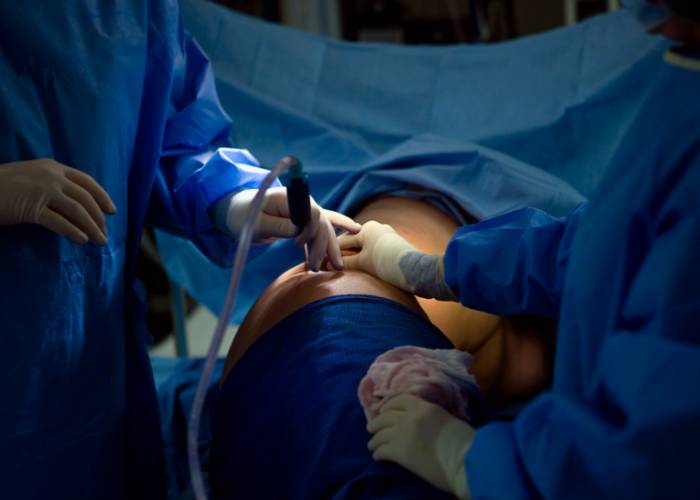 what happens during liposuction