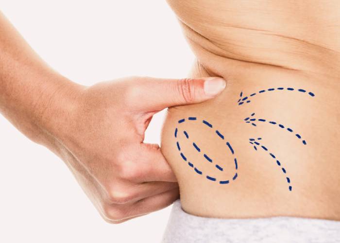 why liposuction is popular