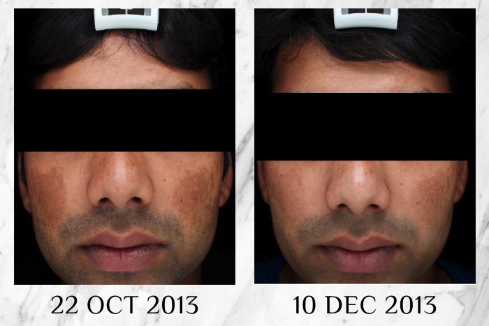 crystal tomato whitening supplement before after results