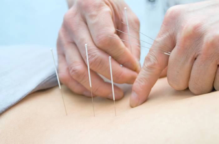 electro acupuncture for obesity