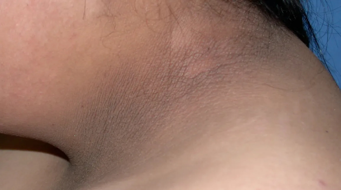 PCOS Skin Symptoms Acanthosis Nigricans