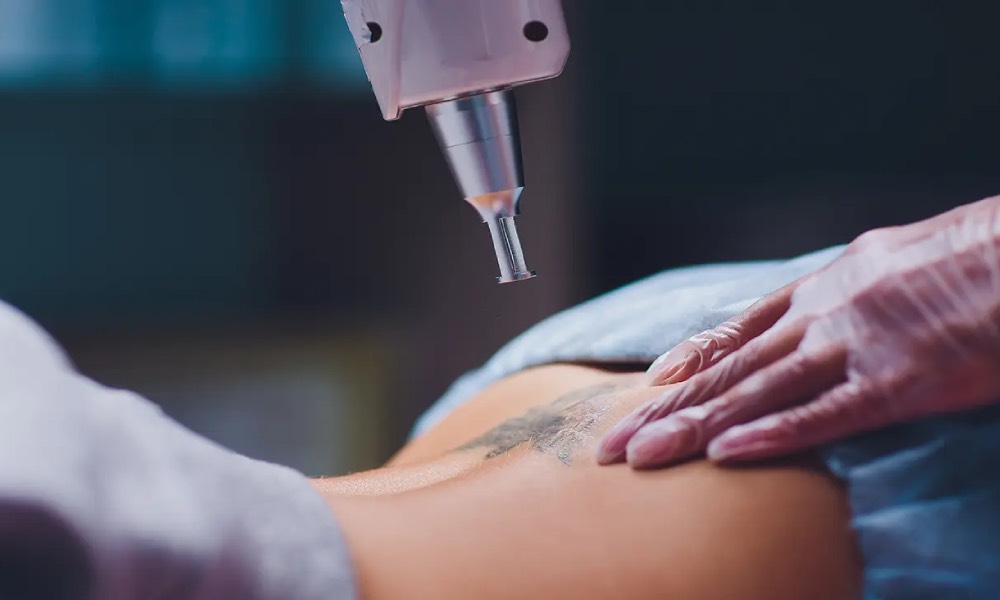 tattoo removal clinic - Amaris B. Clinic