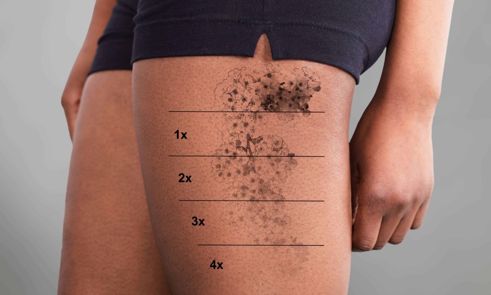 tattoo removal clinic - Ensoul Medical Clinic-3