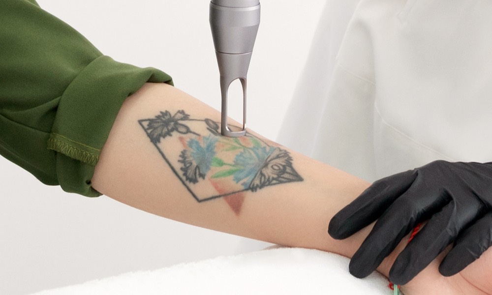 15 Top Tattoo Removal Clinics to Erase Your Ink in Singapore
