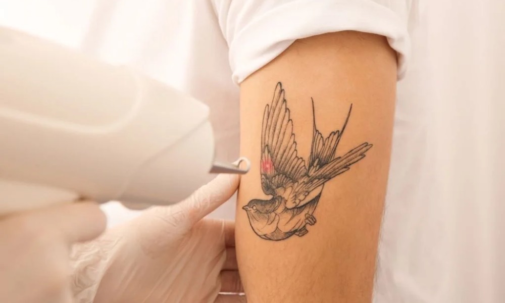 tattoo removal clinic - V Medical Aesthetics & Laser.
