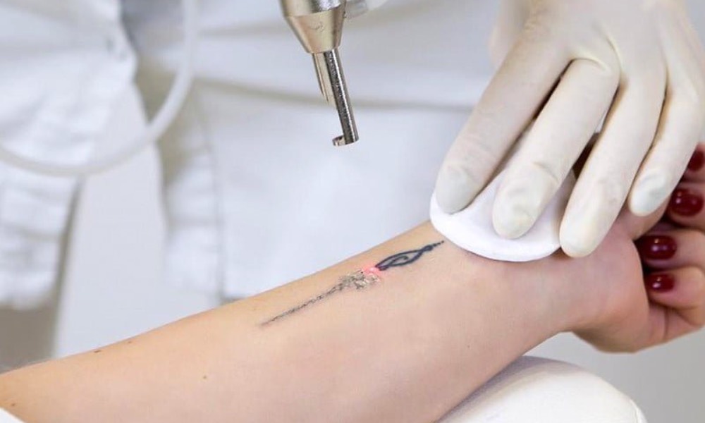 tattoo removal clinic - V Medical Aesthetics & Laser