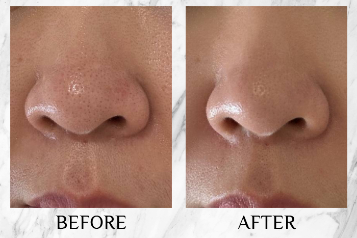 bioderma sensibio micellar cleansing oil blackheads