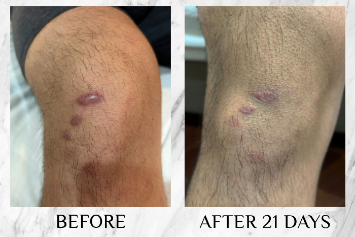 BioRNA Antiscar keloid scar results