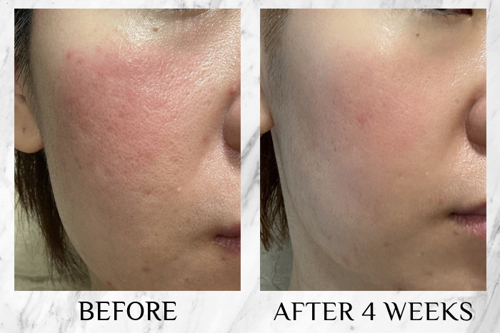 CurrentBody LED Light Therapy Face Mask Series 2 results