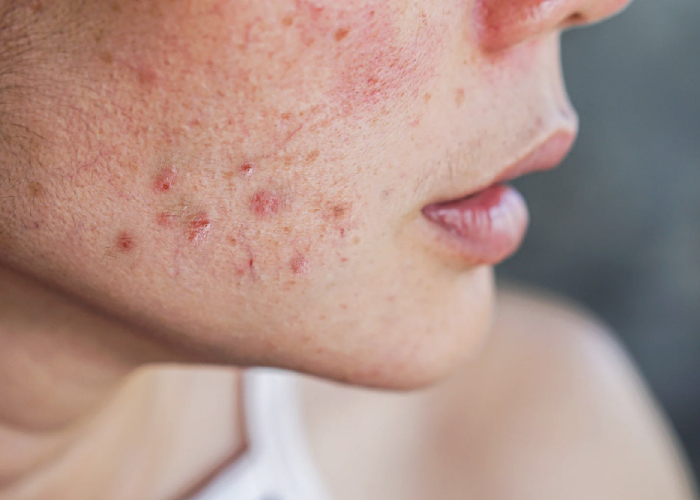 emerging korean skincare ingredients acne care